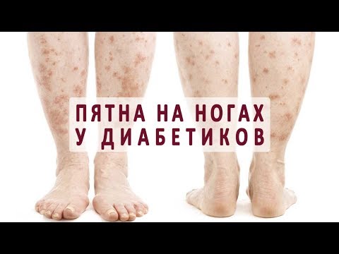 Отбеливание кожи не летом Как избавится от веснушек на лице навсегда