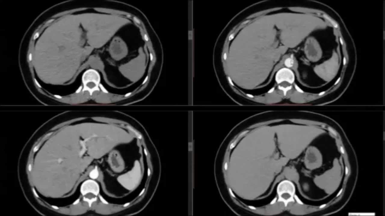 TC do Abdome: Fases do contraste venoso