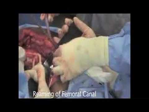 Distal End Femur Radical Excision 3/4