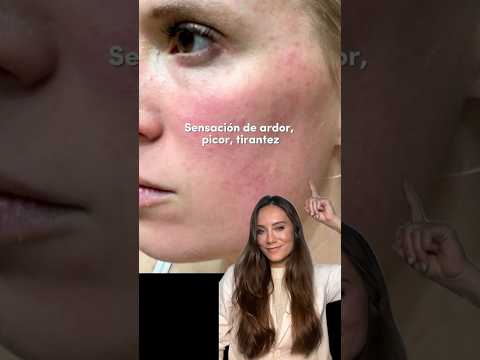Cómo se ve y se siente la #rosacea #dermatologist #skincare