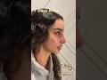 Scarless Facelift And Revision Rhinoplasty By Dr TAS