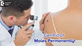 Can Mole Be Removed  Permanently? - Dr. Renuka Shetty | Doctors
