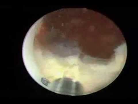 Prostatitis Exazerbation Schwere Video Frau tun Prostatamassage