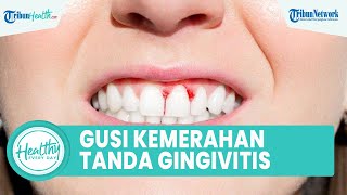 Sering Diabaikan! Gusi Kemerahan dan Mudah Berdarah Tanda Alami Gingivitis, Ini Kata Dokter