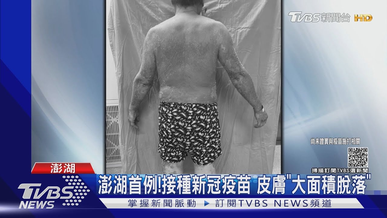 澎湖首例!接種新冠疫苗後 全身「紅疹、脫皮」