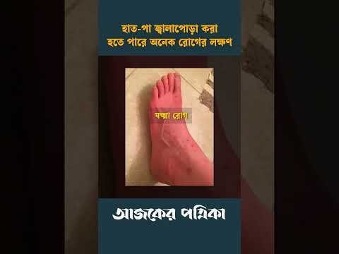 হাত-পা জ্বালাপোড়া করা হতে পারে অনেক রোগের লক্ষণ | Ajker Patrika