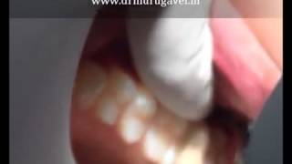 preview picture of video 'Upper Wisdom tooth removal in chennai-video'
