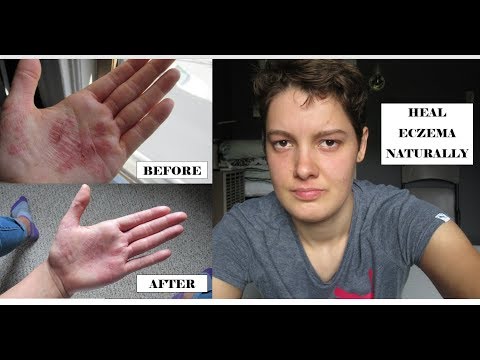 Il menù che si nutre a dermatite atopic Eczema in una vagina