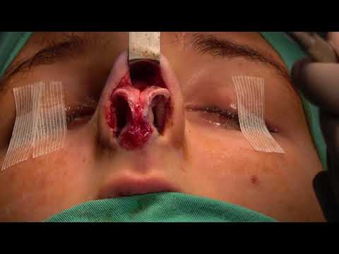 Rinoplasti ameliyatında burun nasıl açılır? (Açık Rinoplasti)