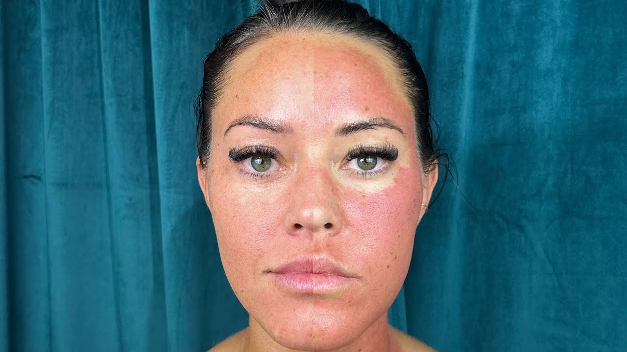 Opus Laser Skin Resurfacing