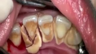 Top nasty teeth washed by doctor