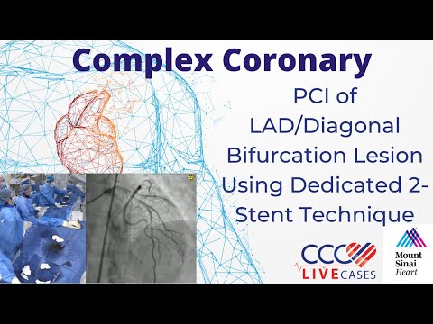 PCI of LAD/Diagonal Bifurcation Lesion Using Dedicated 2-Stent Technique