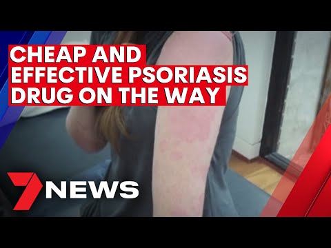 Psoriasis flare up causes