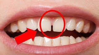 क्या आपके दांतों के बिच गैप है?Is there gap in teeth? दांतों के बीच गैप है उसके बड़े रहस्यों को जाने