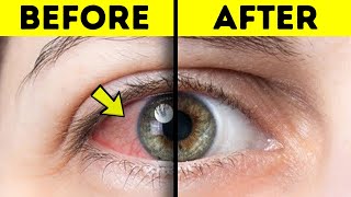 How To Get Rid of Red Eyes Without Eye Drops Fast - 3 Ways to Get Rid of Red Eyes