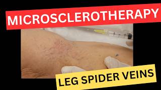 Microsclerotherapy Masterclass: How to Inject Spider Veins - A FREE Guide for Doctors and Nurses