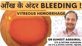 आँख के अंदर BLEEDING ! Vitreous  Hemorrhage ! जाने कारण, लक्षण और इलाज l