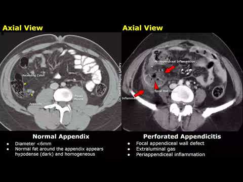 Appendix CT Scan Normal Vs Appendicitis Images | Acute, Gangrenous Types & Perforated Appendix