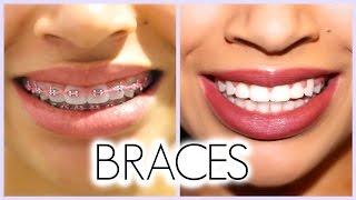 MY 3 YEAR BRACES EXPERIENCE!! (Before/After + Q & A)