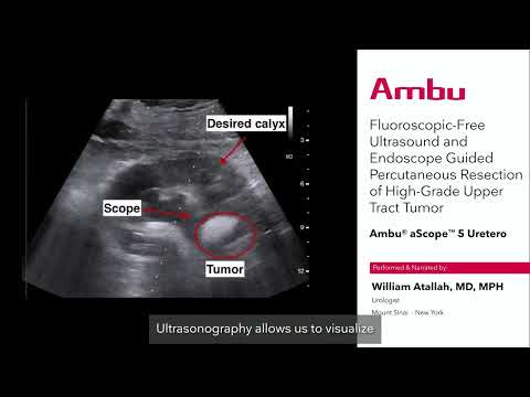 aScope 5 Uretero Dr. Atallah Narration procedure