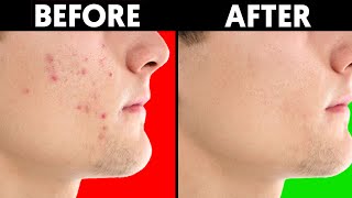 How to Get Rid of Acne Fast and Overnight / Natural Acne Removal / Treat Acne Naturally #shorts