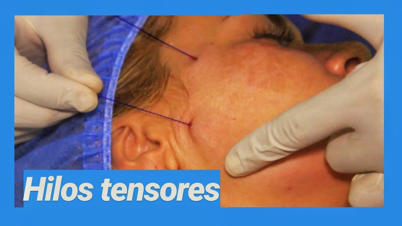 TUTORIAL / HILOS TENSORES / HILOS DE COLAGENO - REJUVENECIMIENTO FACIAL - MEDELLIN