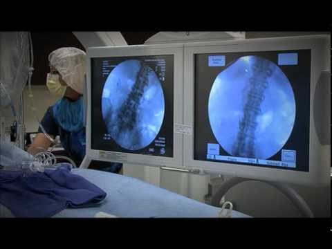 Endovascular Thrombectomy IVC Filter Retrieval