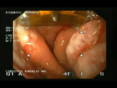 Barrett's Esophagus - Halo 90 Endoscopic Therapy