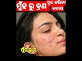 Muhan Ru Brana Dura Kariba Kemiti How To Remove Pimple Of Face Nuakatha Pimple Sadhu Bani Odia S