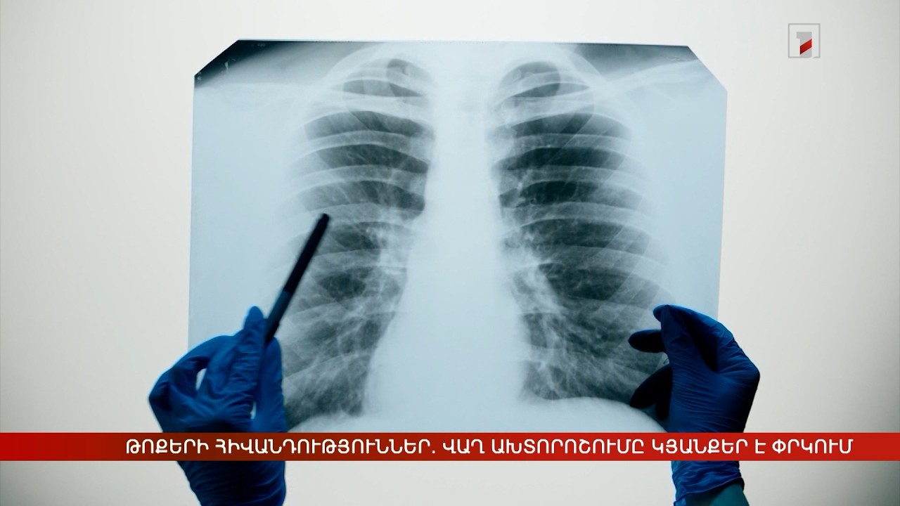 Թոքերի հիվանդություններ. վաղ ախտորոշումը կյանքեր է փրկում
