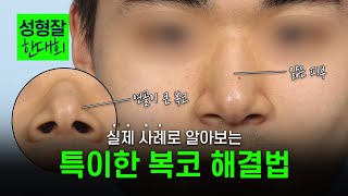 EDITION TV - 피부가 얇고 지방층은 적은데 연골이 큰 복코 | 특이 케이스 복코 성형