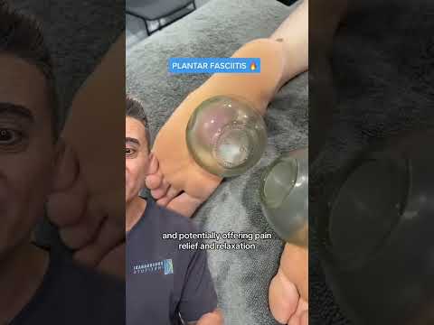 Cupping Therapy for Feet | The Ultimate Plantar Relief Technique?