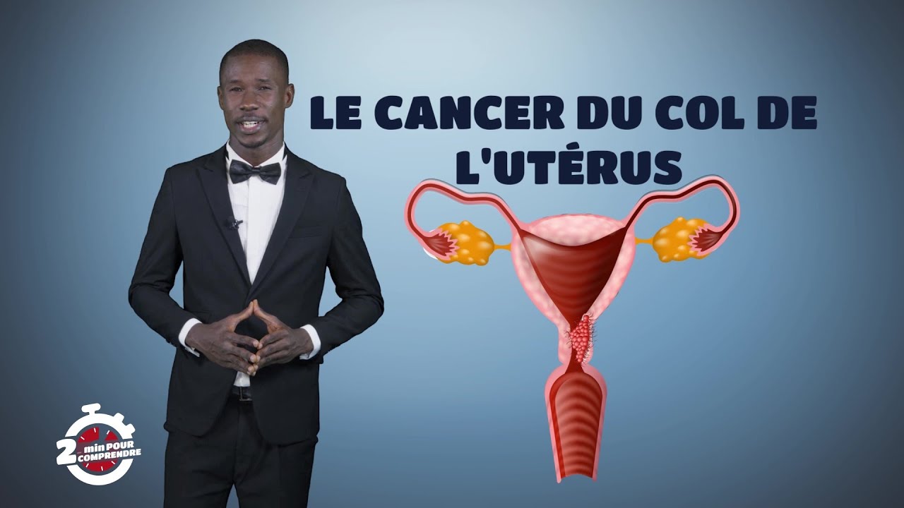 2mn pour comprendre LE CANCER DU COL DE L'UTERUS par Polus Agathon