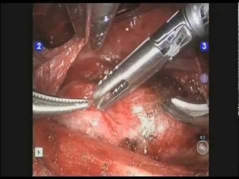Robotic Thyroidectomy Transaxillary
