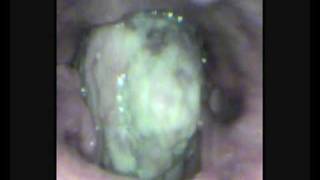 preview picture of video 'Carcinoma Rt. Pyriform Sinus Obstructing the supraglotis.wmv'