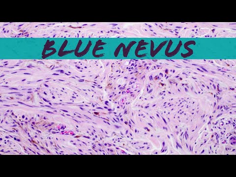 Blue Nevus (pathology dermpath dermatology dermatopathology)