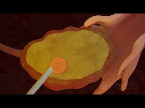 Egg Collection: An Insight into the Procedure