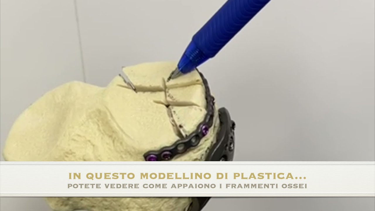 Watch Now FRATTURA DEL PIATTO TIBIALE: osteosintesi con placca e viti FRATTURA DEL PIATTO TIBIALE: osteosintesi con placca e viti