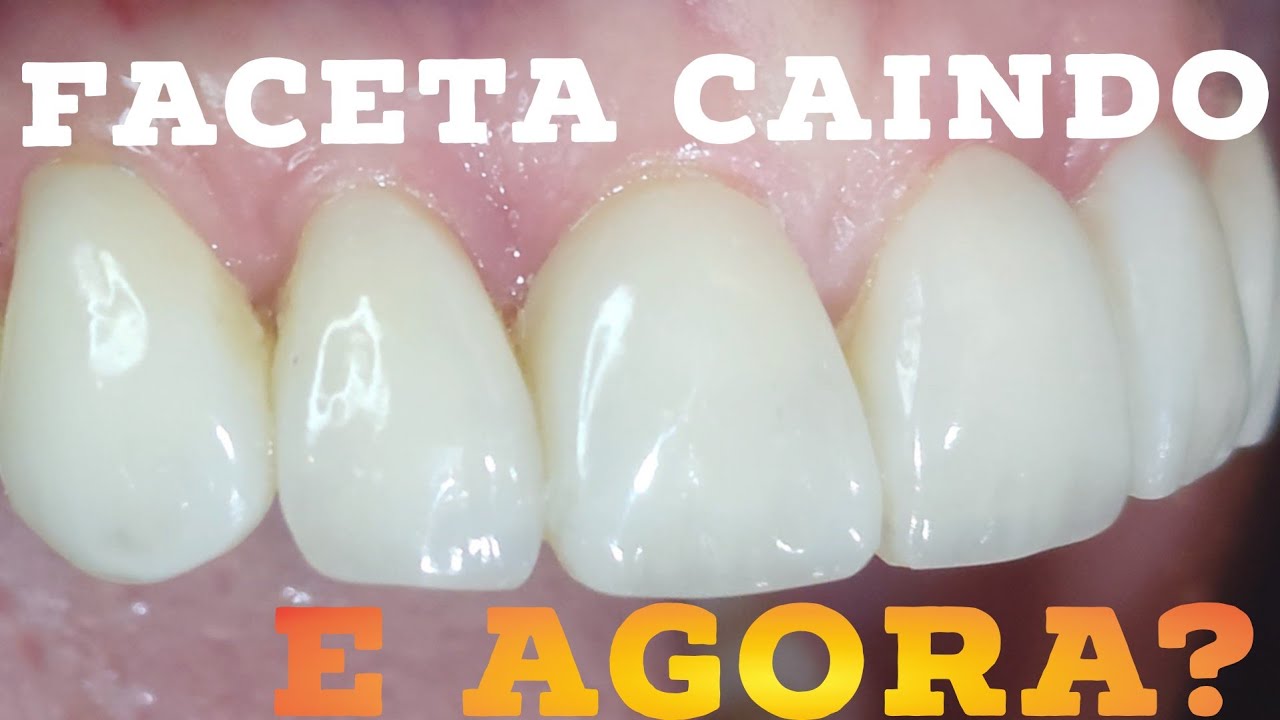 🛑FACETAS CAINDO E LASCANDO!😳E agora o que fazer????