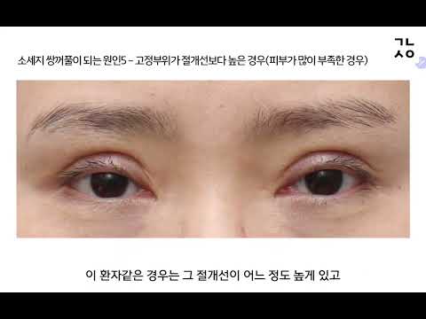 二重まぶた初めての手術 PART3 ソーセージ二重になる9つの原因