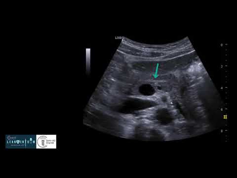 Sonography of the pancreas