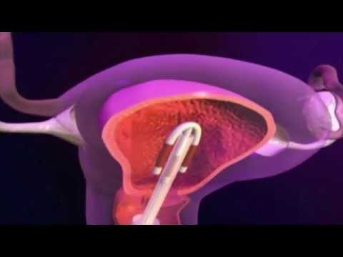 comment poser un ovule