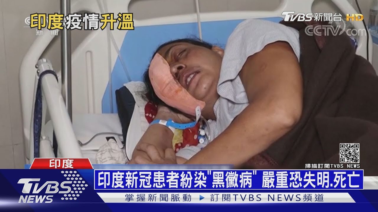 印度新冠患者紛染「黑黴病」 嚴重恐失明、死亡