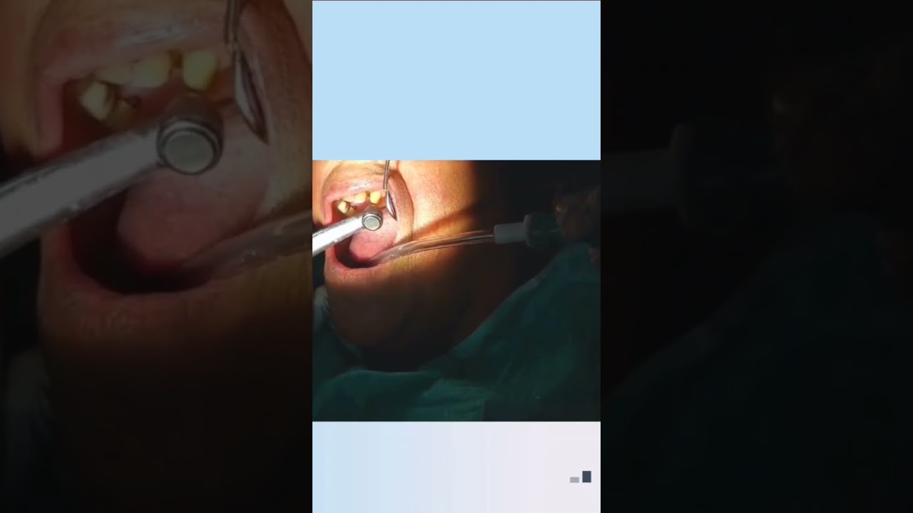 Crown Preparation #shortsviral #trending #dentist #dentistryworld #crown #preparation