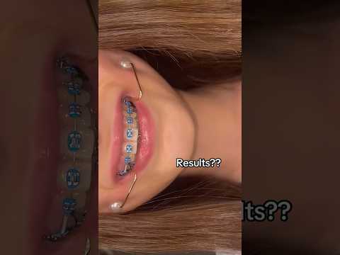 Can you Really Get Dimples Using THIS Device?! 🦷😬