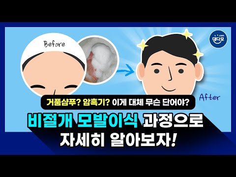 "泡沫洗发水？还是黑暗期？" "这到底是什么单词？"通过非切开毛发移植过程来详细了解一下吧！！