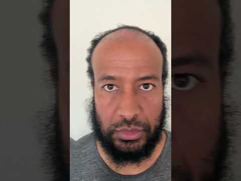 1 Year Afro Hair Transplant Turkey Results #shorts #hairtransplant #hairtransplantturkey