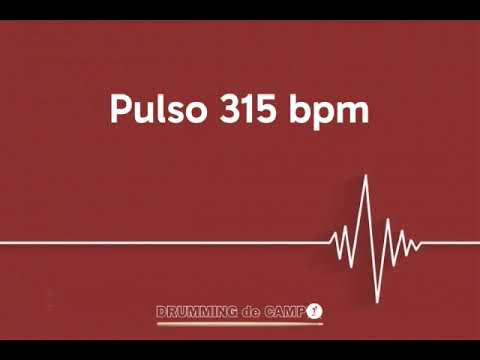 Pulso 315 bpm