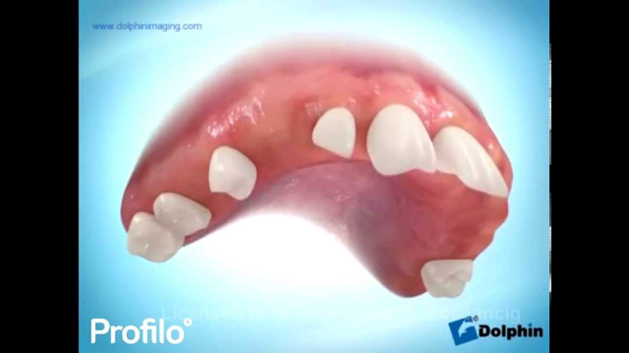 Replacing missing teeth - Full Mouth Reconstruction with Dental Implants