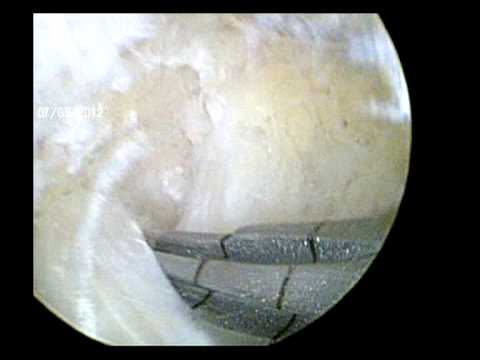 comment soigner ligament croisé